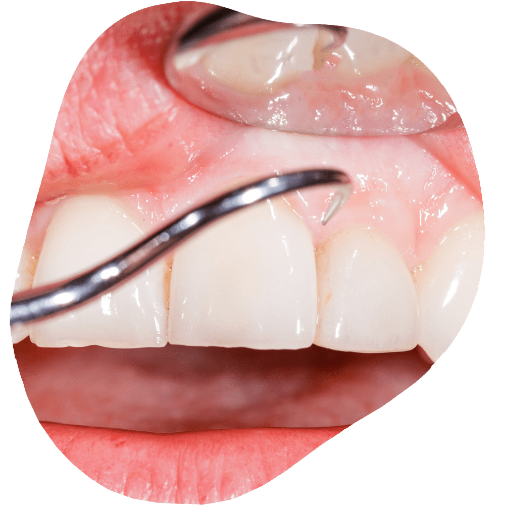 Deep Cleaning | Toothville Family Dentistry | NW Calgary | General Dentist