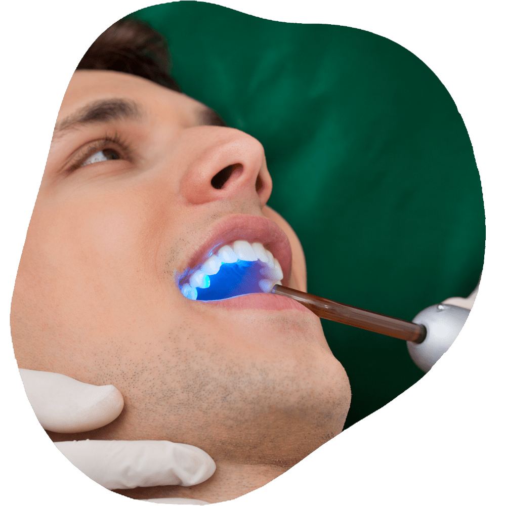 Dental Bonding | Toothville Family Dentistry | NW Calgary | General Dentist