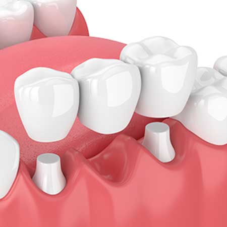 Dental Bridge | Toothville Family Dentistry | NW Calgary | General Dentist