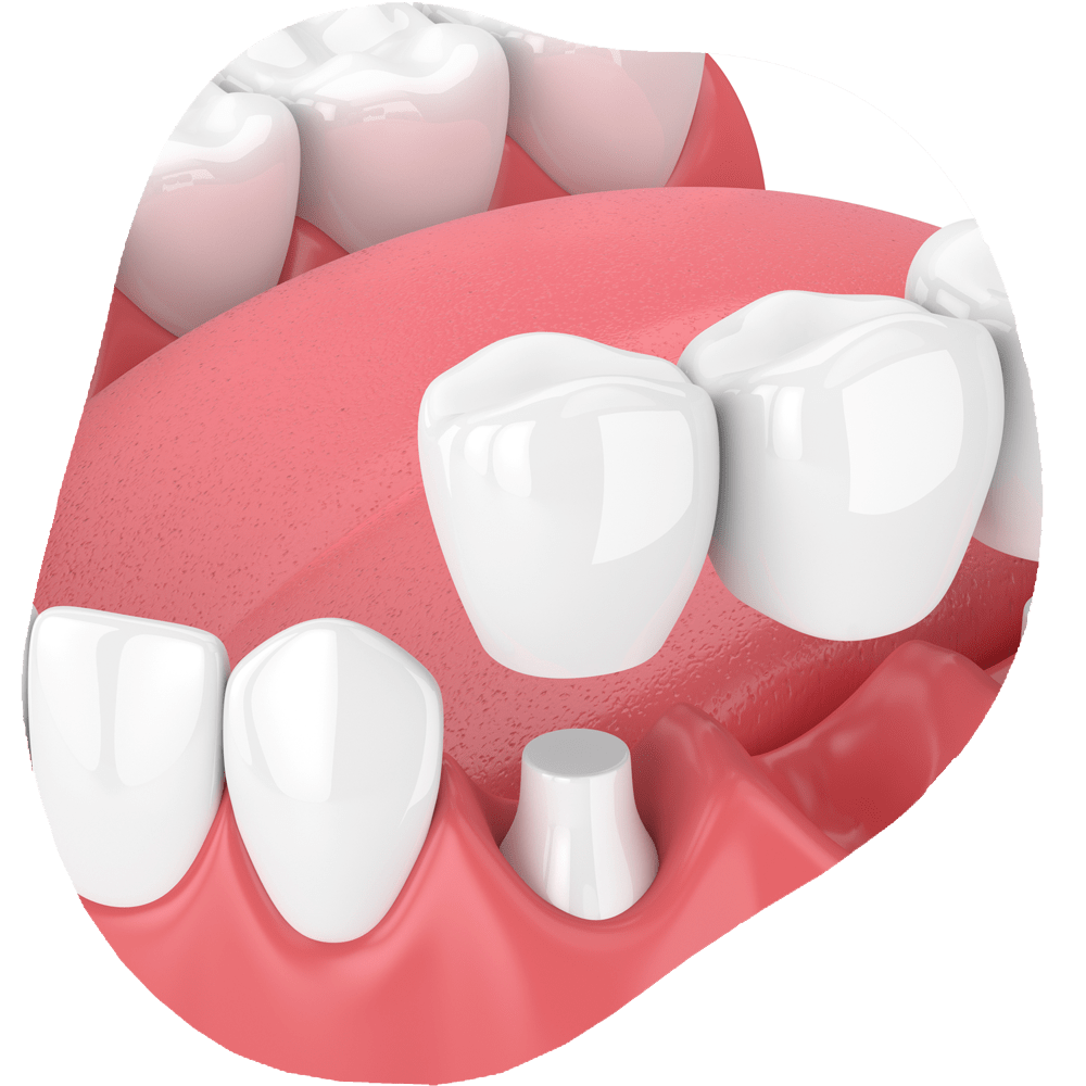 Dental Bridge | Toothville Family Dentistry | NW Calgary | General Dentist