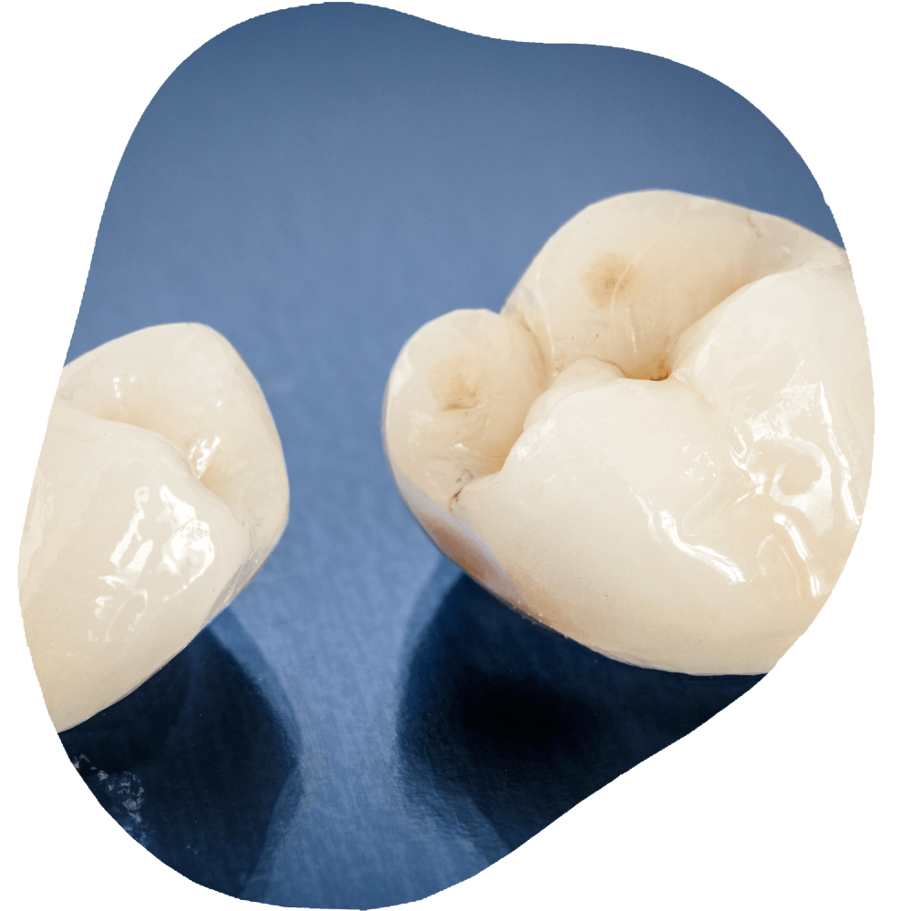 Dental Crown | Toothville Family Dentistry | NW Calgary | General Dentist