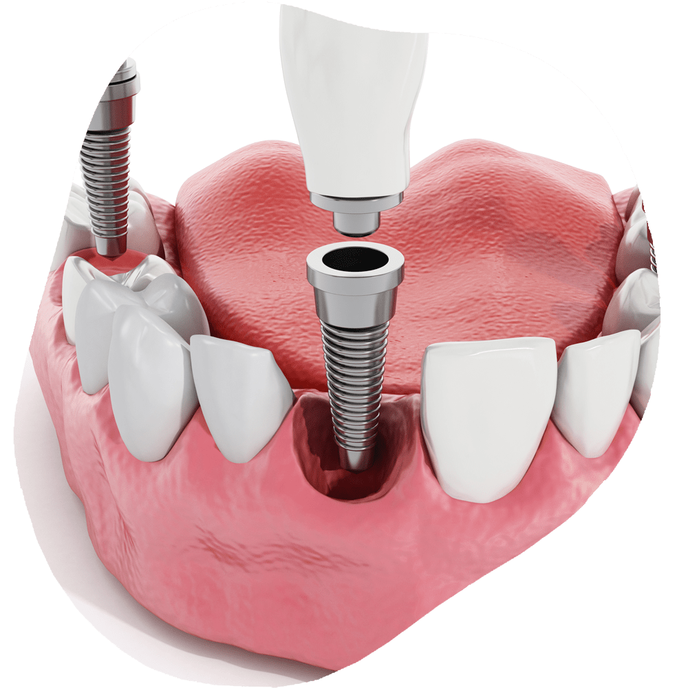 Dental Implants | Toothville Family Dentistry | NW Calgary | General Dentist