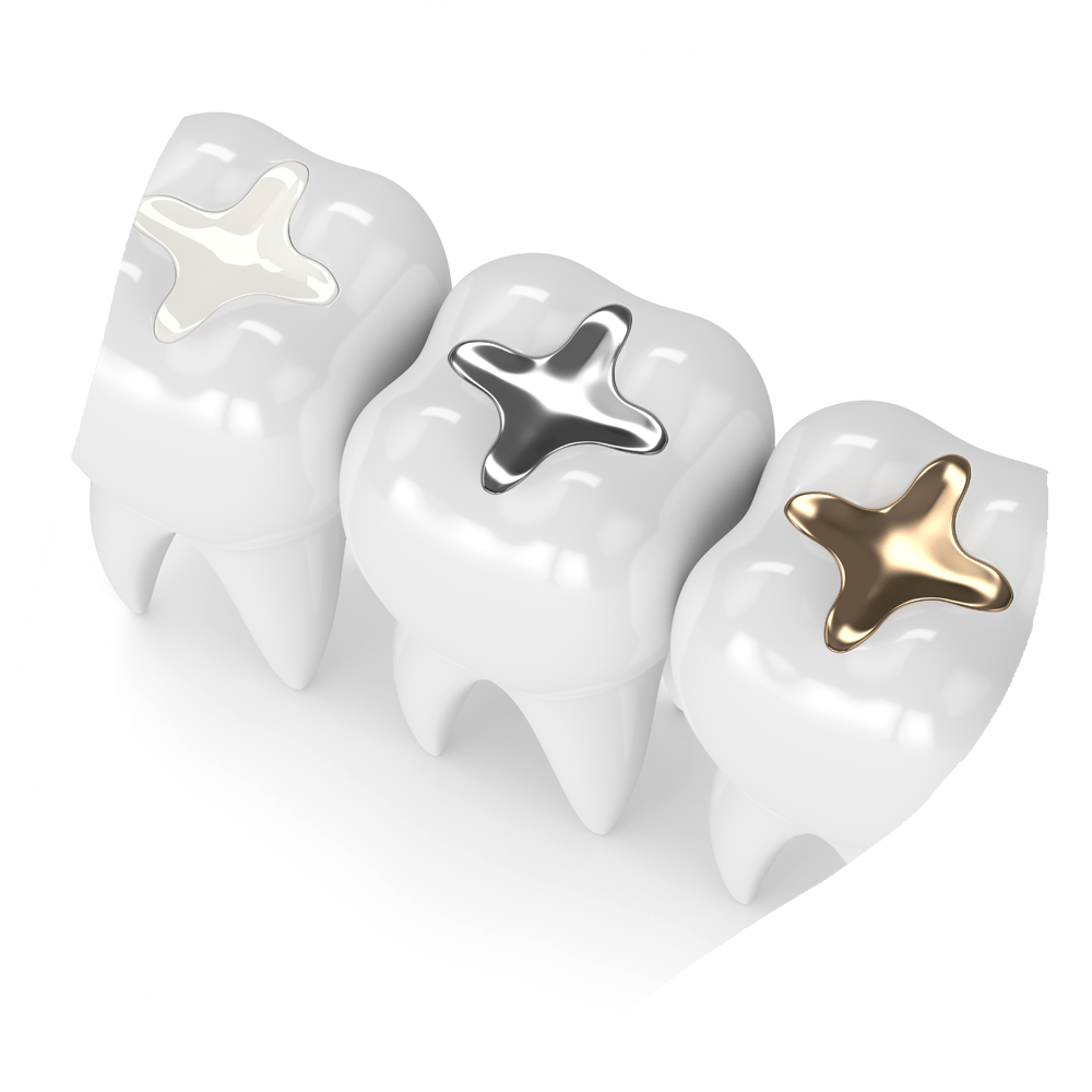 Fillings | Toothville Family Dentistry | NW Calgary | General Dentist