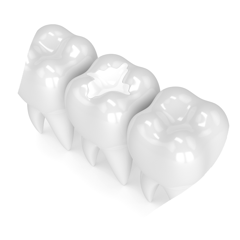 Inlay and Overlay | Toothville Family Dentistry | NW Calgary | General Dentist