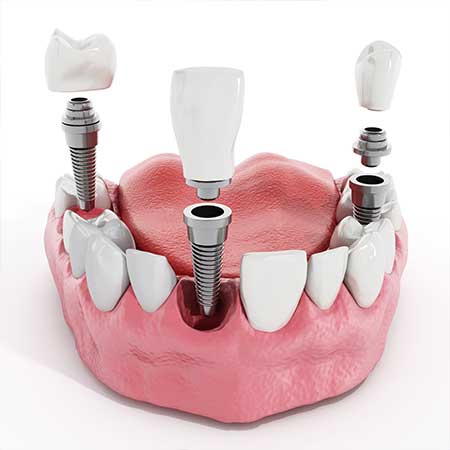 Restorative Dentistry | Toothville Family Dentistry | NW Calgary | General Dentist