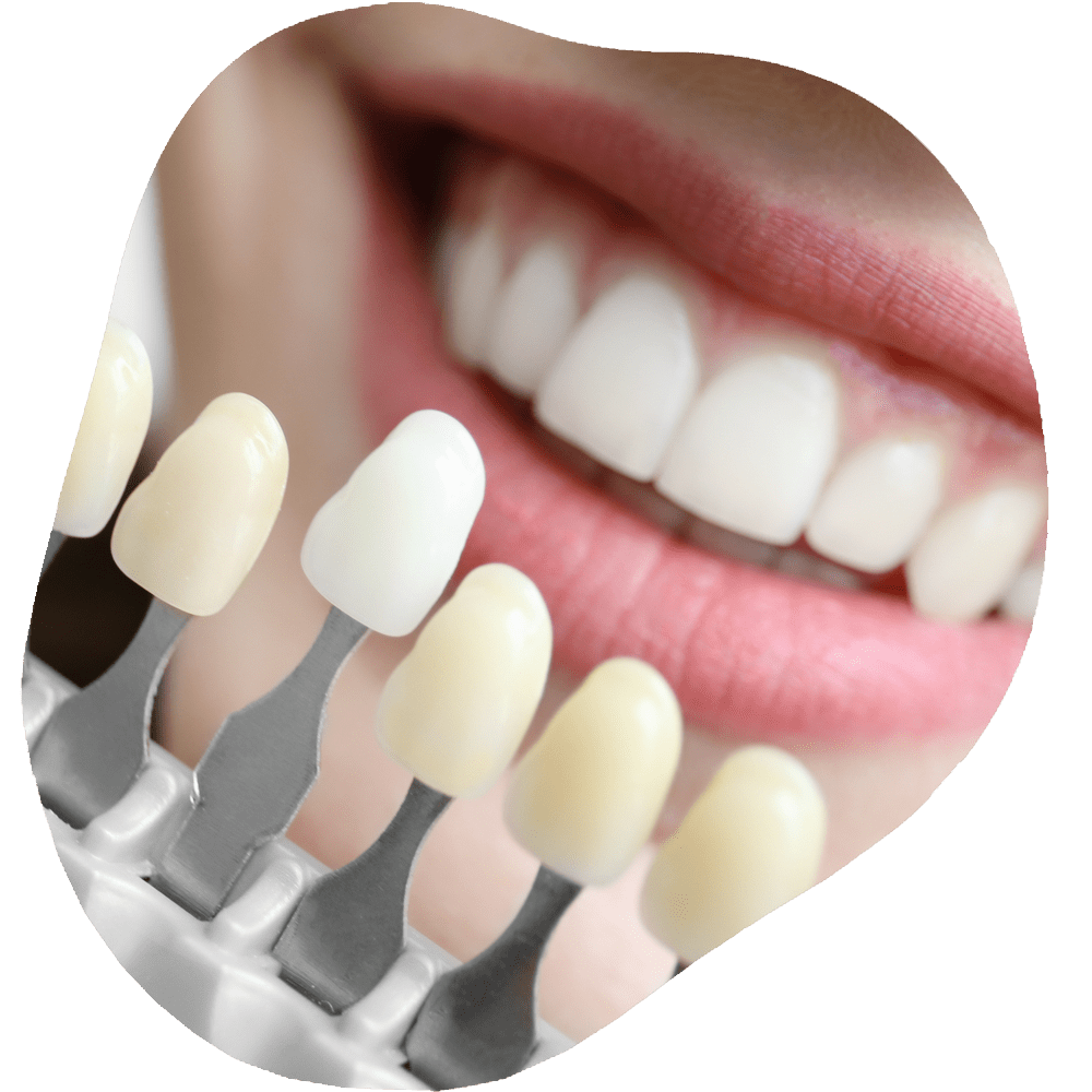 Dental Veneers | Toothville Family Dentistry | NW Calgary | General Dentist